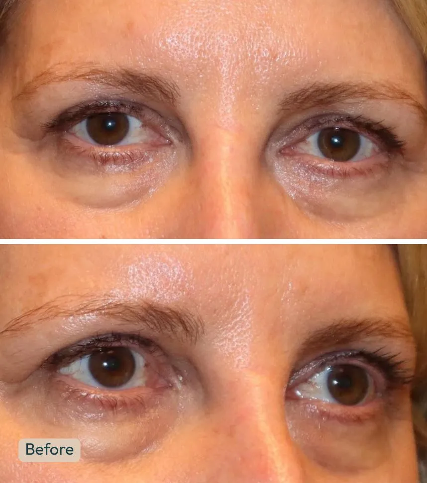 lower eyelid blepharoplasty