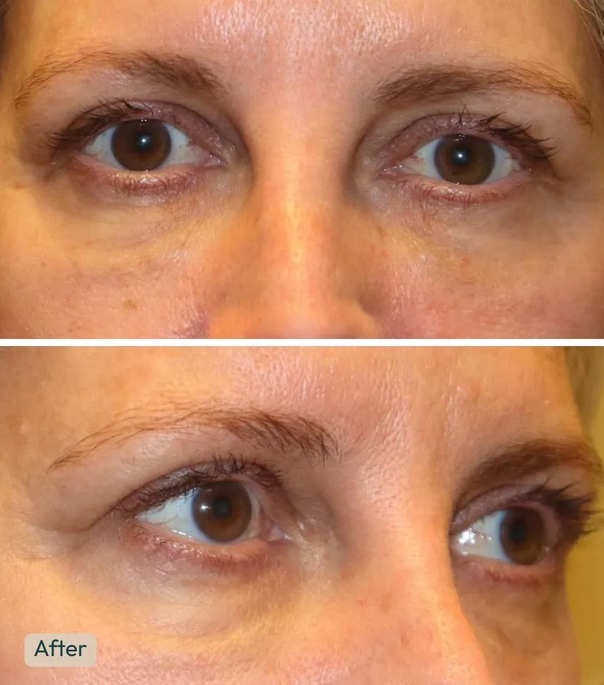 lower eyelid blepharoplasty (2)