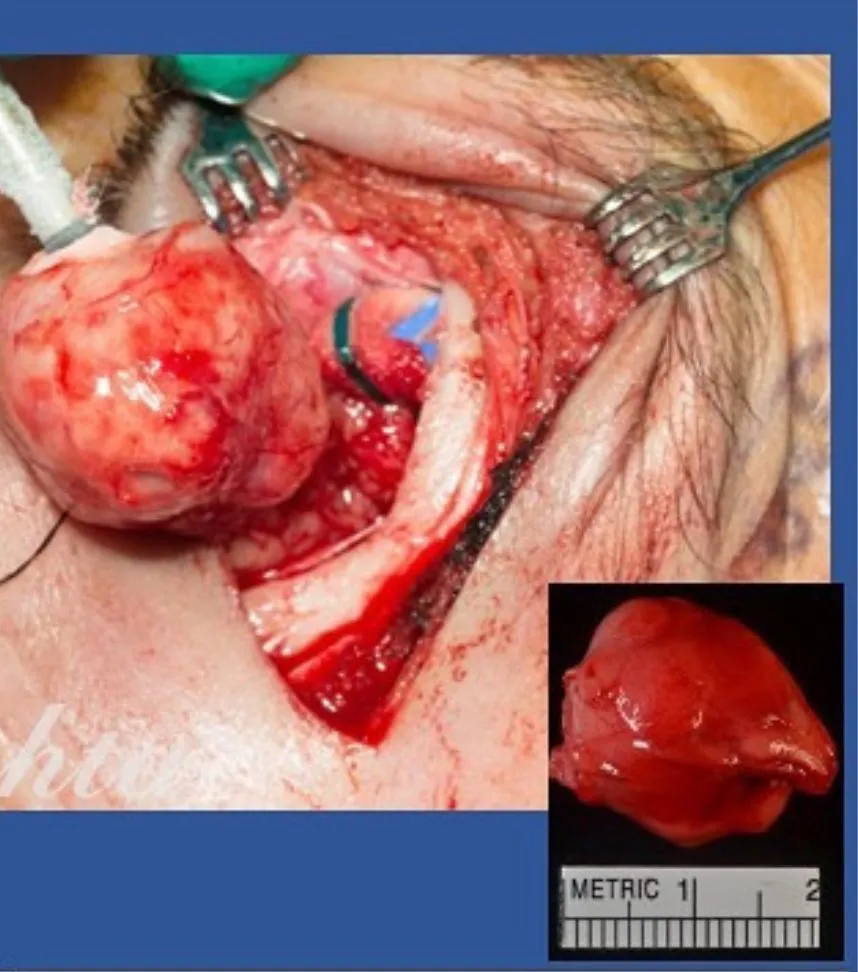 Tumor Removal (3)