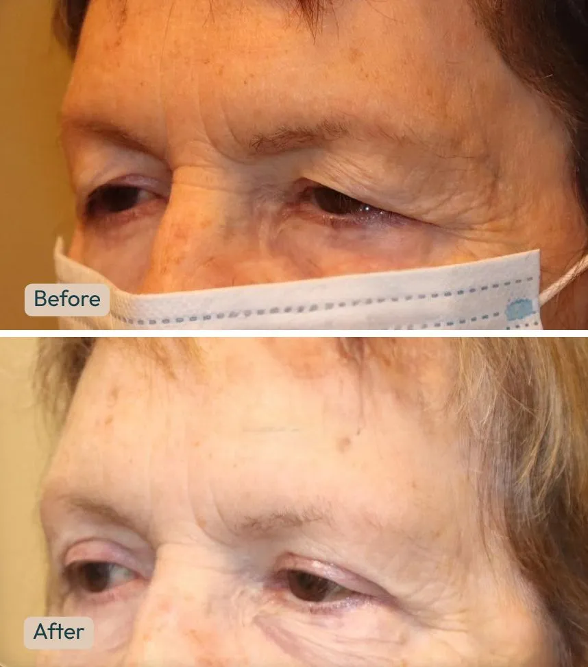 upper blepharoplasty